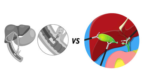 cholecystectomy_and_ERCP