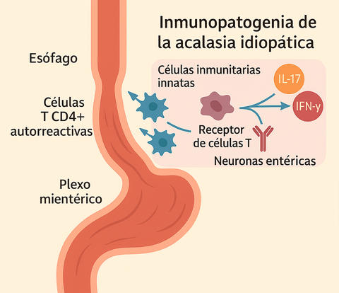 acalasia_idiopatica_ia_1