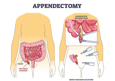 appendicectomy
