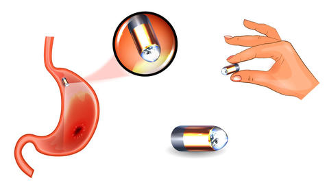 bowel_capsule_endoscopy