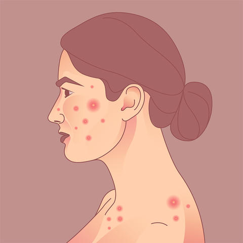 acne_in_nflammatory_bowel_disease